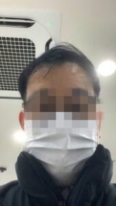 서울성모병원 후발백내장 레이저시술 후기 (12) 애프터 사진 2